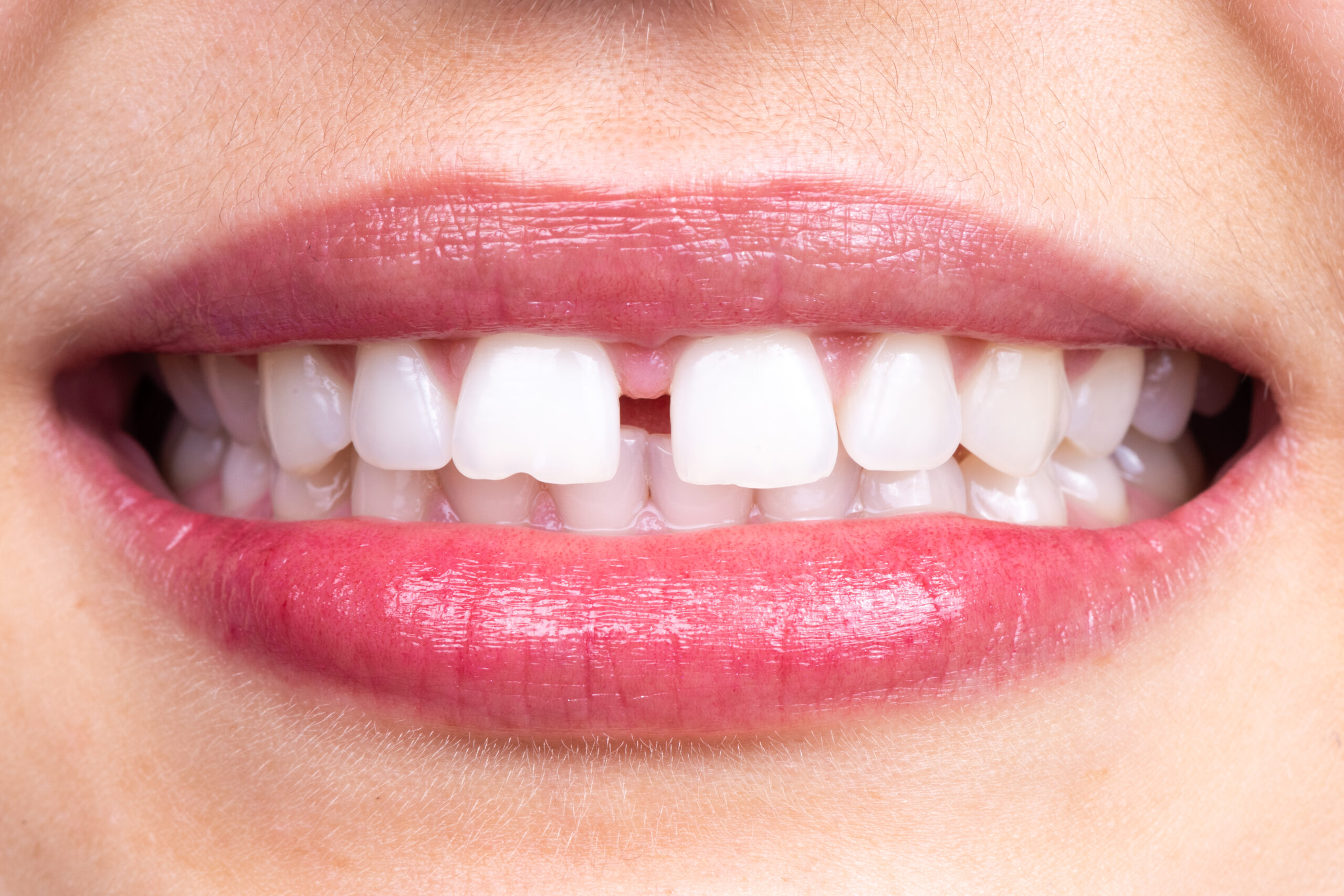 Orthodontic issues in Marietta